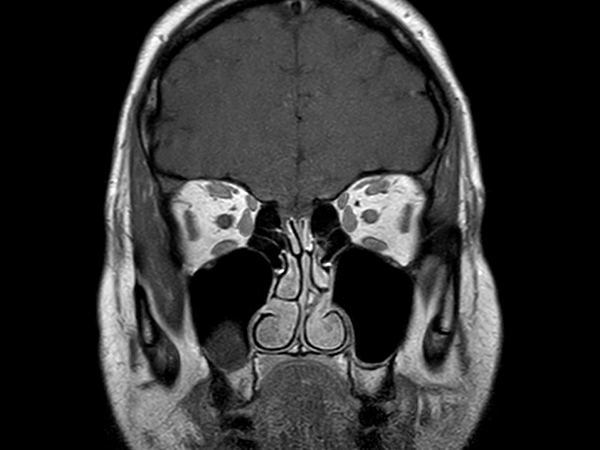 Coronal T1w TSE mDIXON (In Phase)<p>Post-Gado