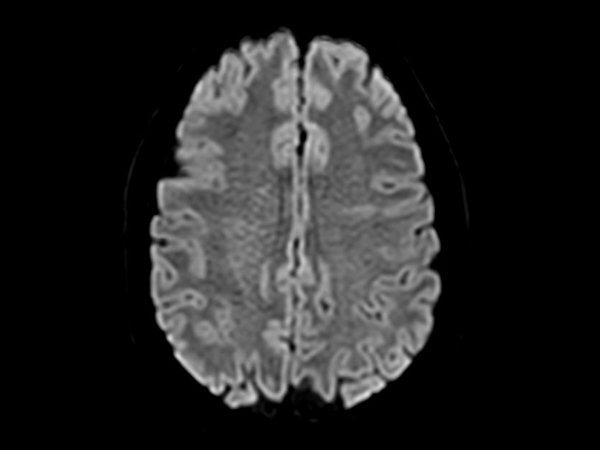 Axial Diffusion (b1000)