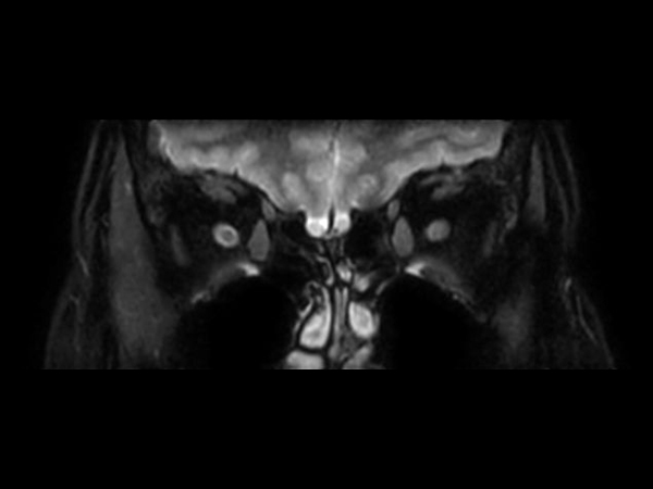 3D VIEW - T2w FatSat (coronal reformat)