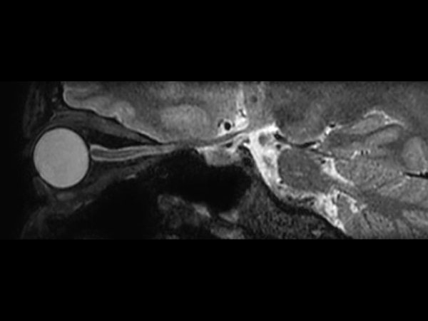 3D VIEW - T2w FatSat (sagittal reformat)