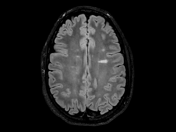 Axial 3D VIEW - T2w FLAIR