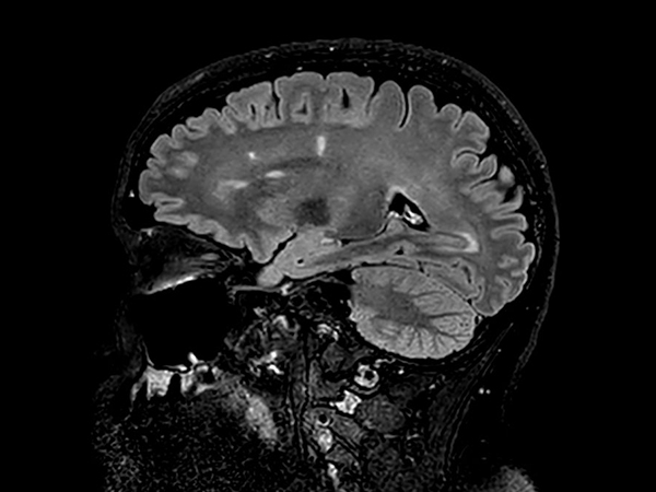 3D VIEW - T2w FLAIR (sagittal reformat)