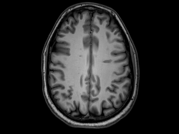 3D VIEW - T1w TSE (axial reformat)<p>Pre-Gado