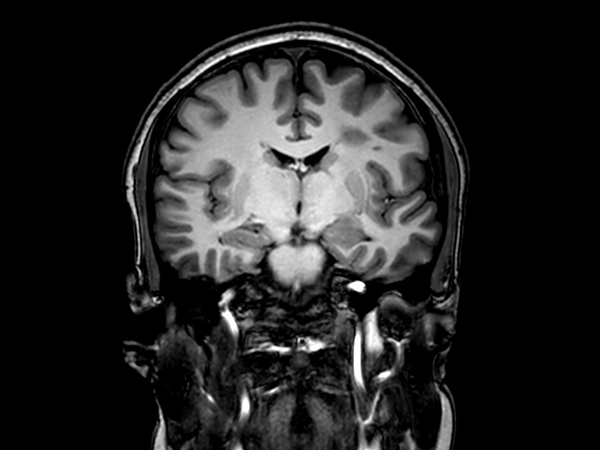3D VIEW - T1w TSE (coronal reformat)<p>Pre-Gado