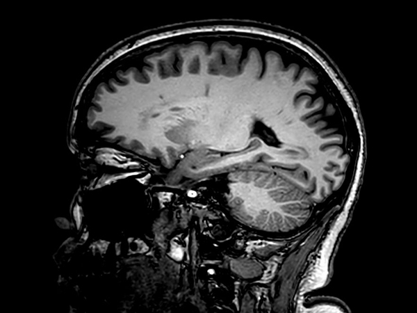 Sagittal 3D VIEW - T1w TSE<p>Pre-Gado