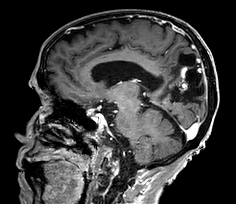 Sagittal 3D T1w FFE +gado