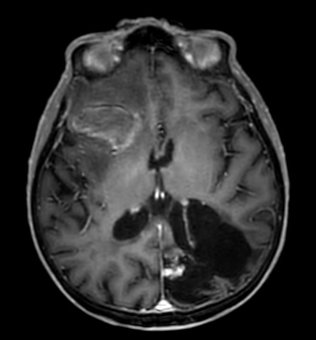 3D T1w FFE (axial reformat) +gado