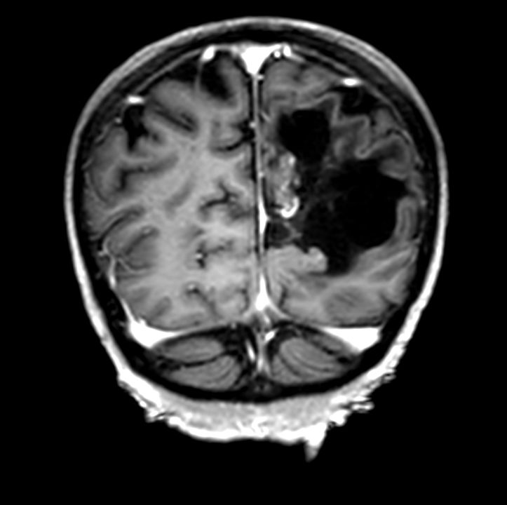 3D T1w FFE (coronal reformat) +gado