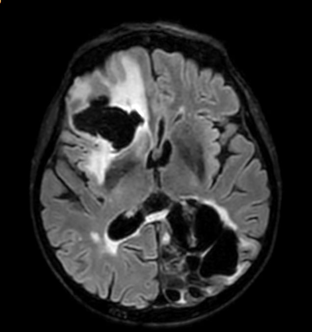 3D VIEW - T2w FLAIR (axial reformat)