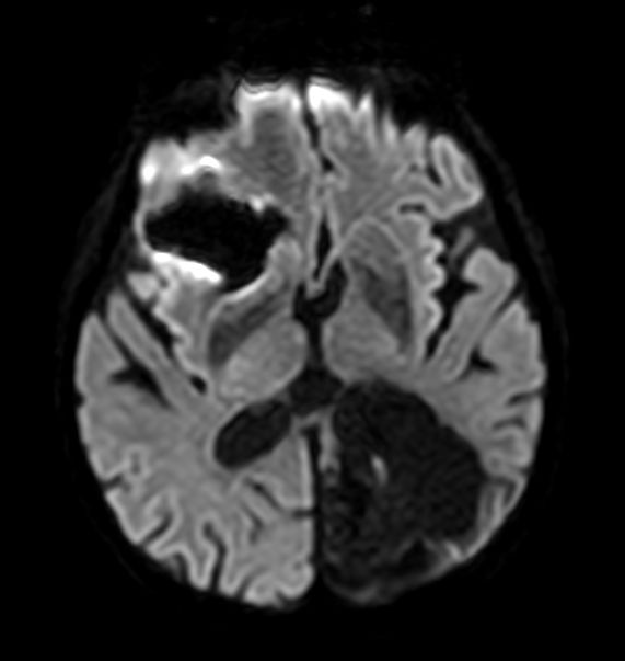 Axial Diffusion (b1000)