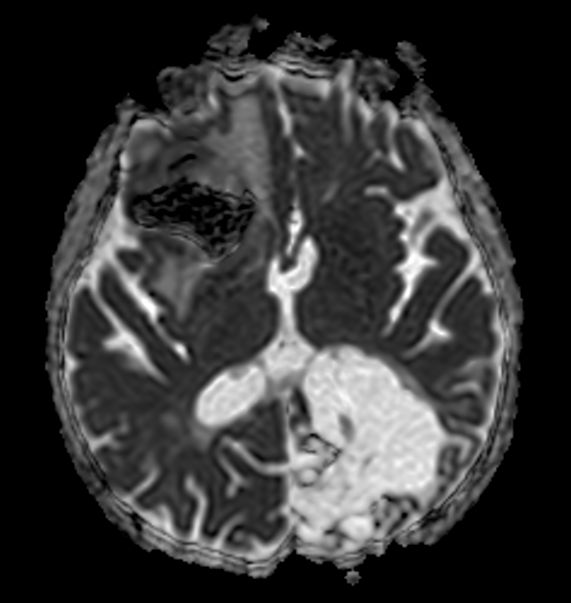 Axial Diffusion (ADC)