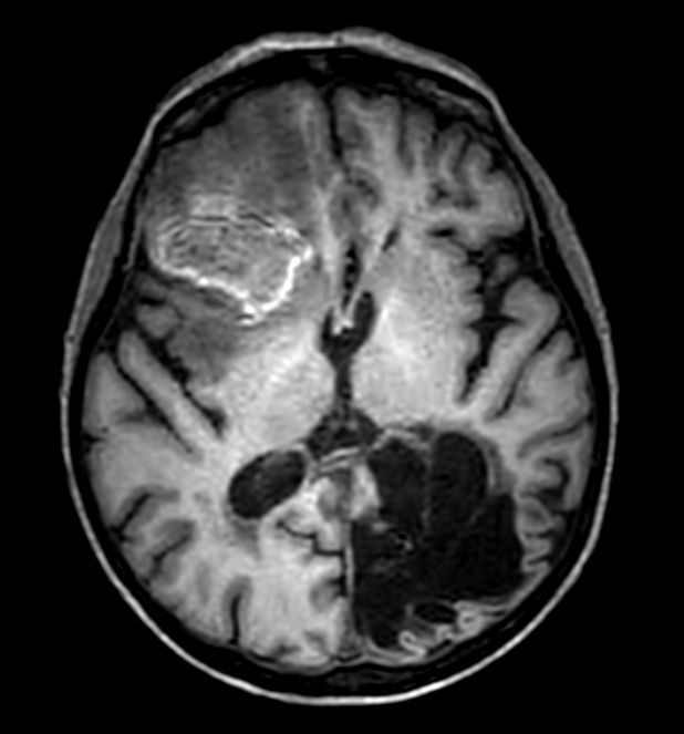 3D T1w FFE (axial reformat)