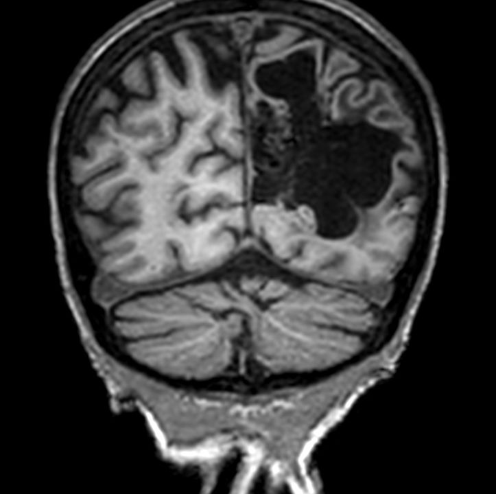 3D T1w FFE (coronal reformat)