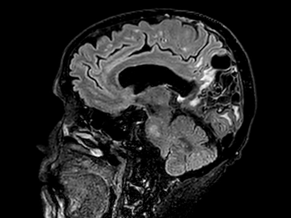 Sagittal 3D VIEW - T2w FLAIR