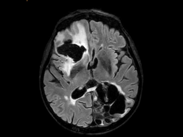 3D VIEW - T2w FLAIR (axial reformat)