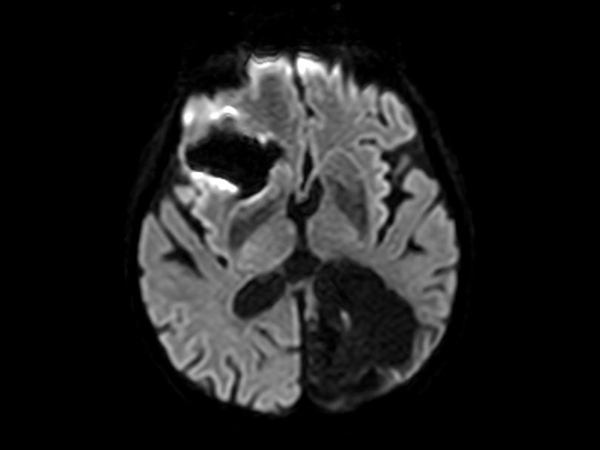 Axial Diffusion (b1000)