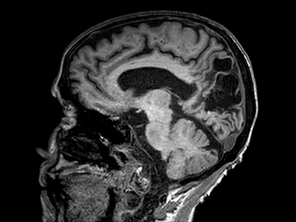 Sagittal 3D T1w FFE