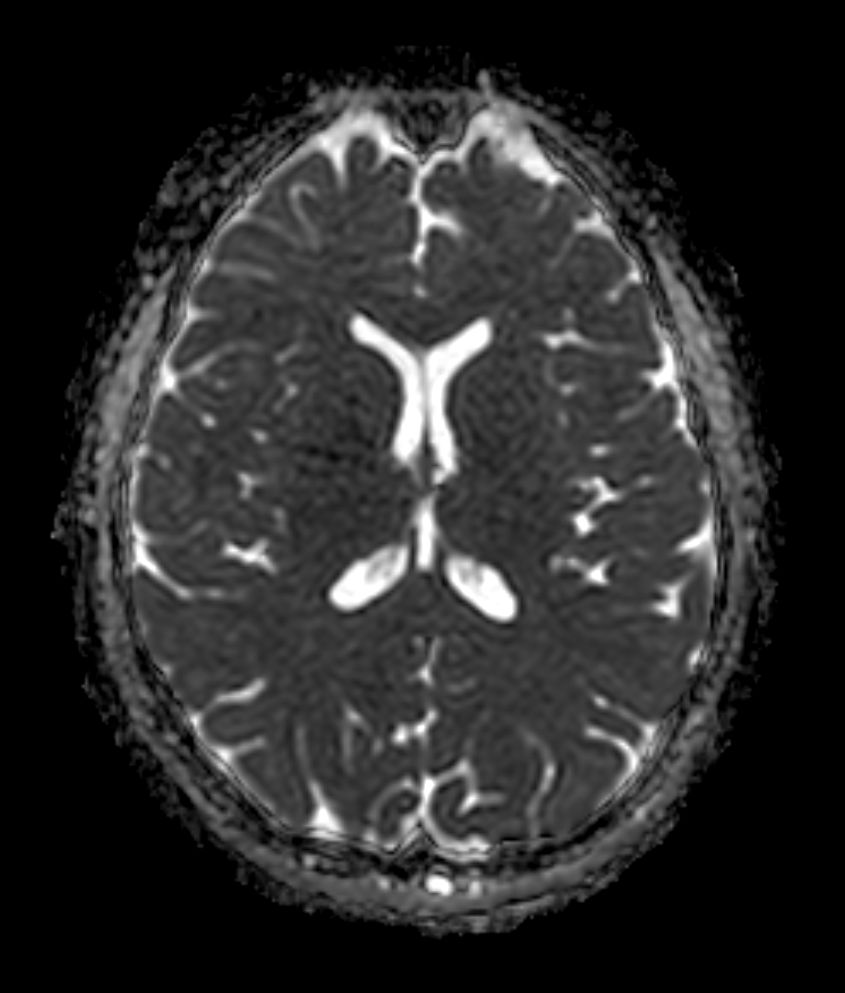 Axial DWI b1000 (ADC)
