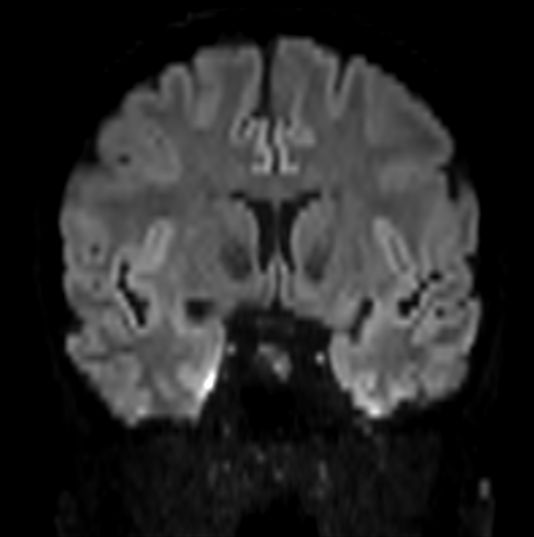 Axial DWI b1000 (Coronal reformat)