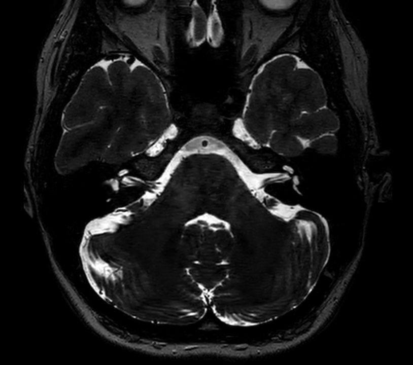 Axial 3D T2w TSE DRIVE