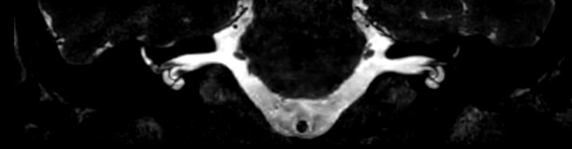 3D T2w TSE DRIVE (Coronal reformat)