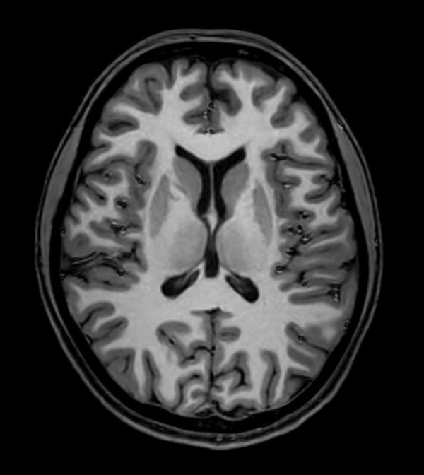 3D T1w TFE (Axial reformat)