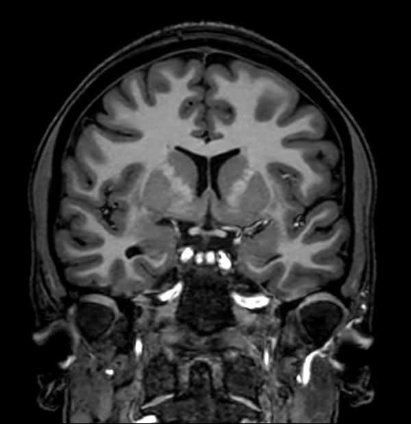 3D T1w TFE (Coronal reformat)
