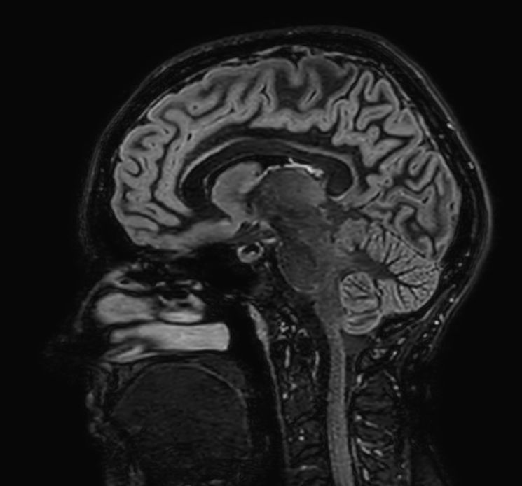 Sagittal 3D Double IR