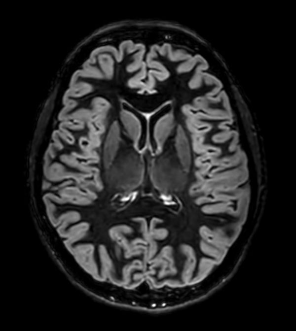 3D Double IR (Axial reformat)
