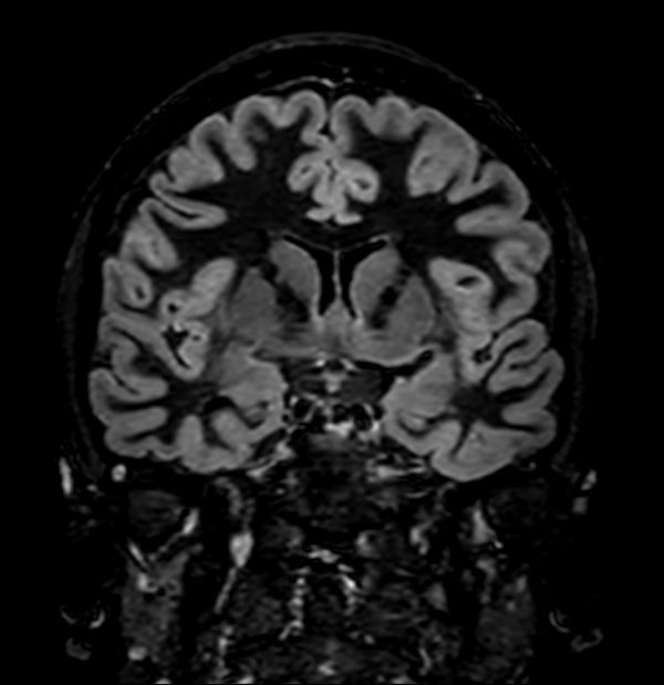 3D Double IR (Coronal reformat)