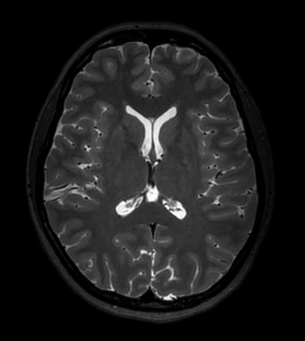 3D T2w TSE (Axial reformat)