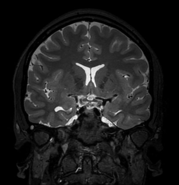 3D T2w TSE (Coronal reformat)