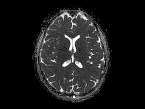 Axial DWI b1000 (ADC)