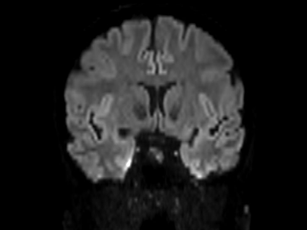 Axial DWI b1000 (Coronal reformat)