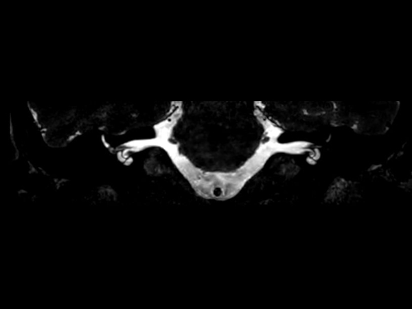 3D T2w TSE DRIVE (Coronal reformat)