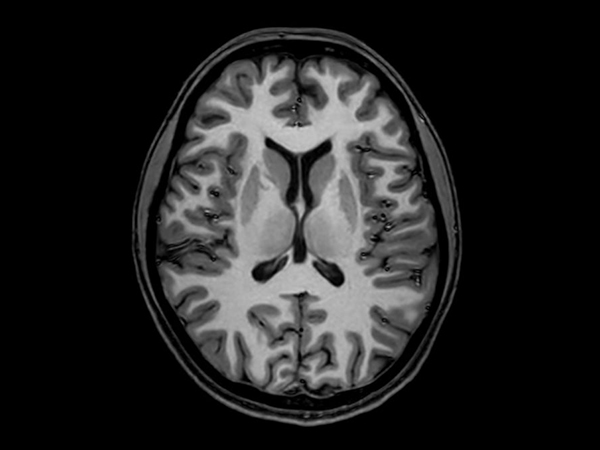 3D T1w TFE (Axial reformat)