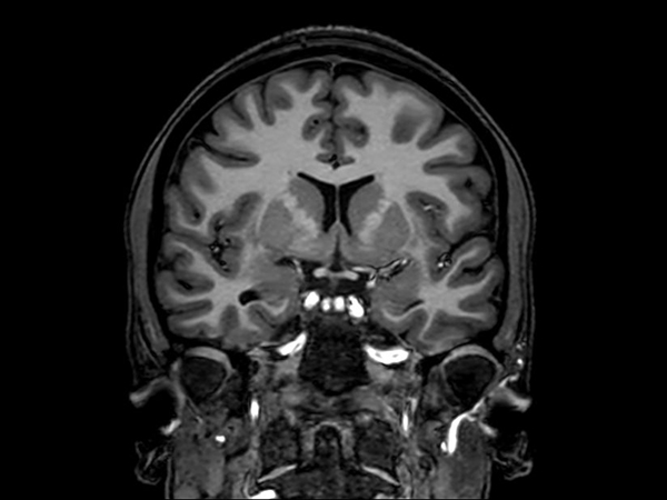 3D T1w TFE (Coronal reformat)