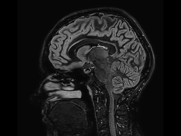 Sagittal 3D Double IR