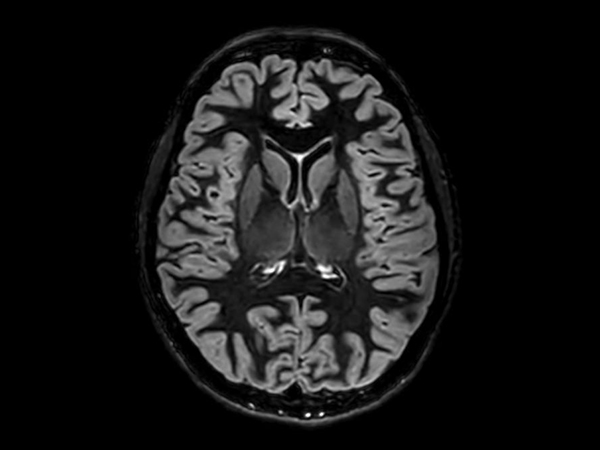 3D Double IR (Axial reformat)