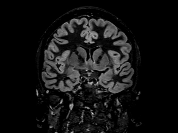 3D Double IR (Coronal reformat)