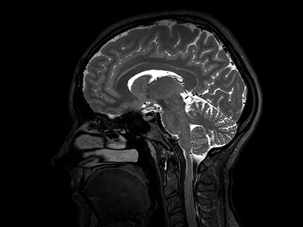 Sagittal 3D T2w TSE