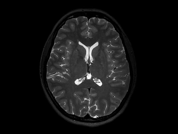 3D T2w TSE (Axial reformat)