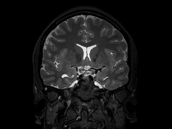 3D T2w TSE (Coronal reformat)