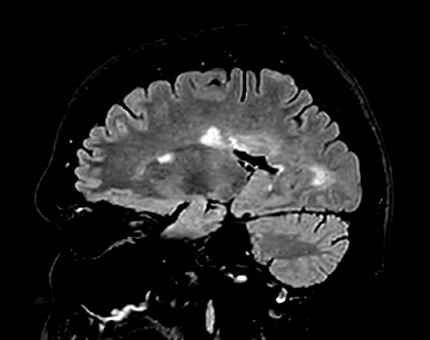 Sagittal 3D FLAIR