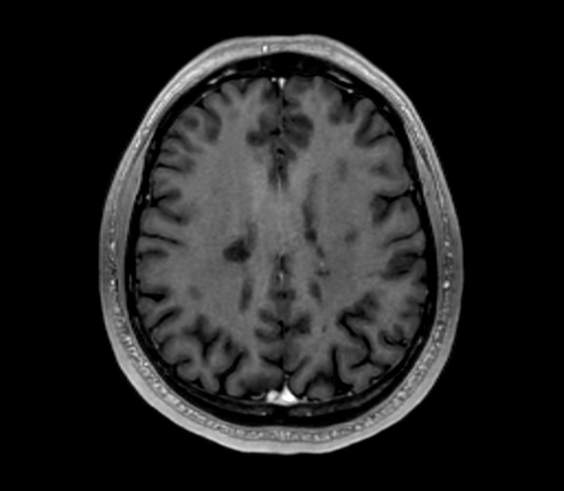 3D T1w TFE (Axial reformat)<b>Post-Gado</b>