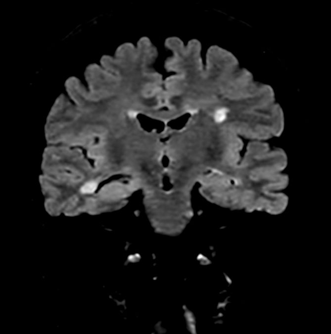 3D FLAIR (Coronal reformat)