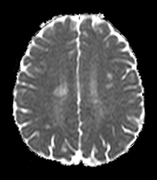 Axial DWI b1000 (ADC)