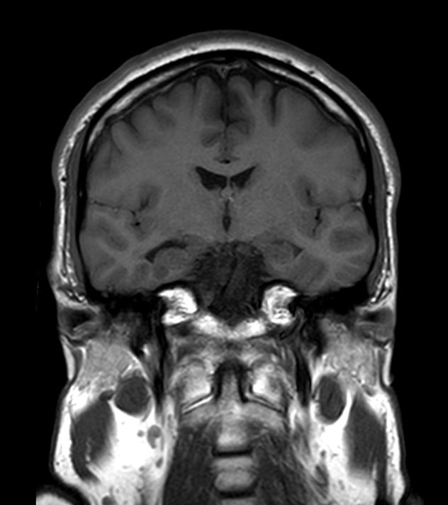 Brain - White matter lesions | Philips MR Body Map
