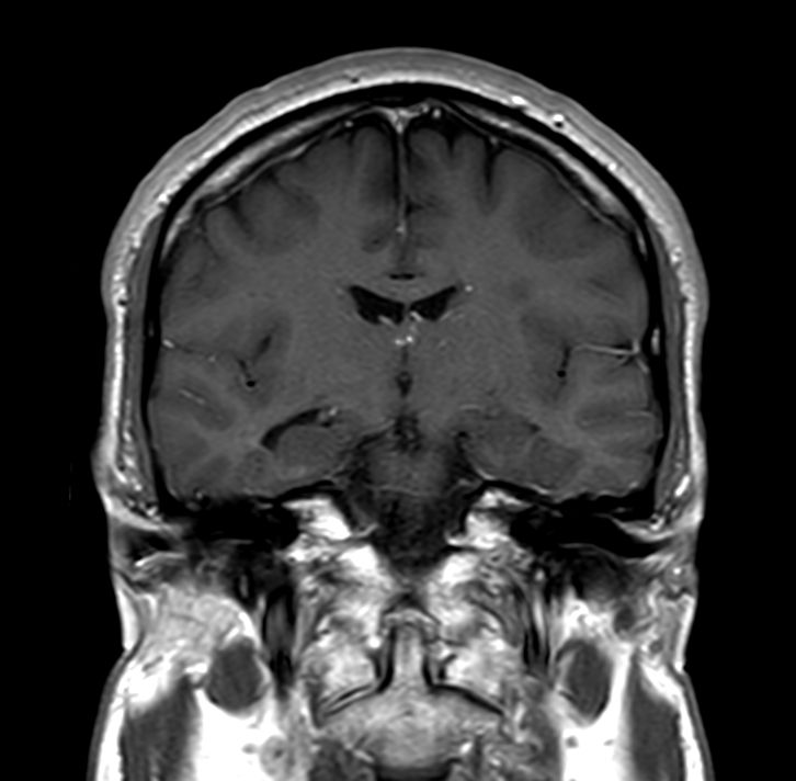 Coronal T1w SE<b>Post-Gado</b>