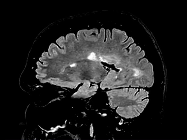 Sagittal 3D FLAIR